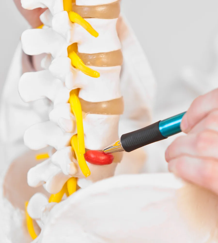 Disc herniation