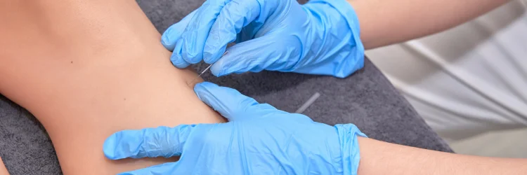 Relieve Painful Muscle Knots with Chiropractic Care and Dry Needling in Raleigh, NC